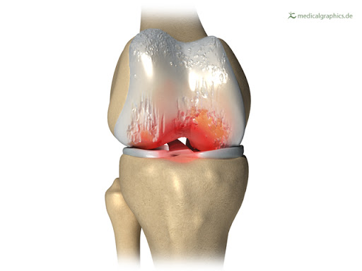 Depiction of arthritis in a knee joint.
